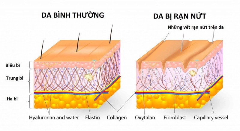 bị rạn da màu đỏ ở bắp chân