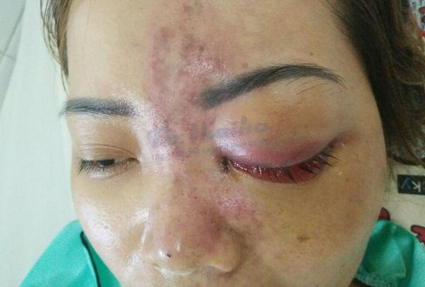Da bị bầm tím sau tiêm filler: Nguyên nhân và cách xử lý hiệu quả